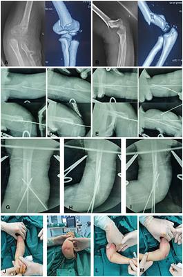 Closed Reduction and Percutaneous Pinning in the Treatment of Humeral Distal Metaphyseal-Diaphyseal Junction Fractures in Children: A Technique Note and Preliminary Results